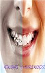 Bracket-free orthodontics