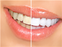 Tooth whitening treatments